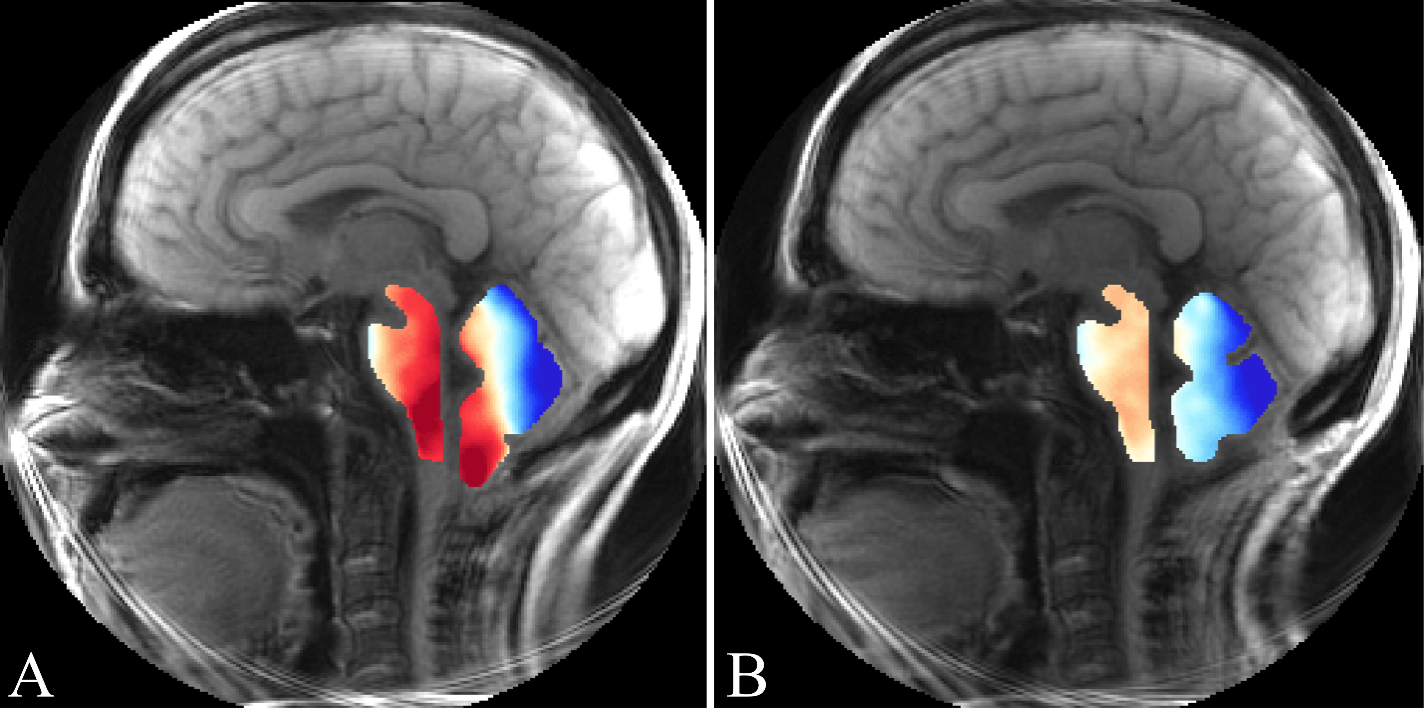 Engr_chiari_scan